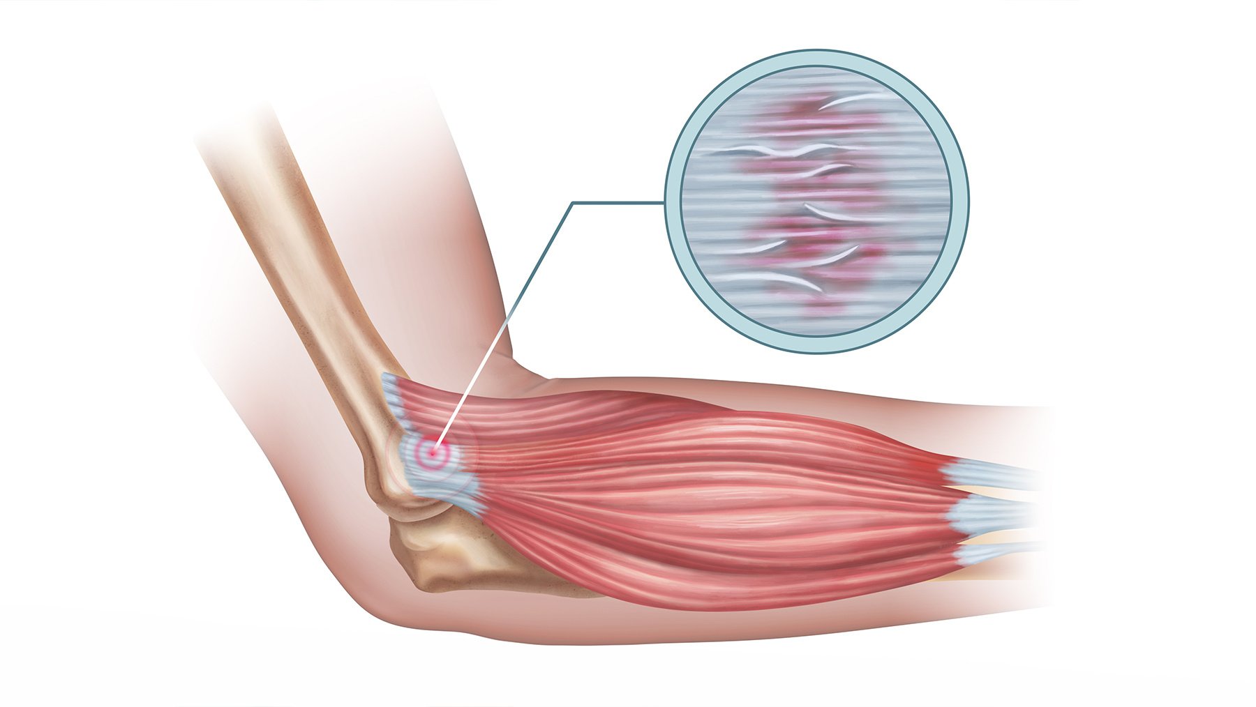 trattamento ortobiologico per i disturbi tendinei